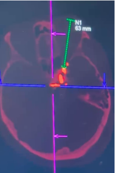 PET/CT image with colored crosshairs and measurement line indicating a 6.3 mm distance near a highlighted intracranial vascular focus