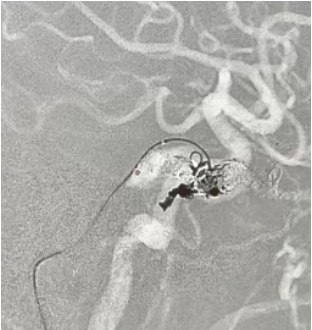 showing a microcatheter and coil mass within a vascular lesion, with surrounding vessels partially opacified by contrast