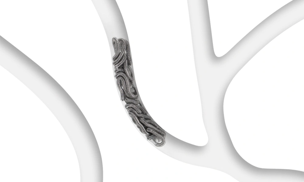 swiftset coiled in an embolization coil