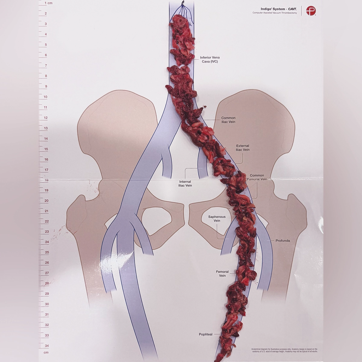 Long, branching blood clot specimen arranged over a labeled diagram of the inferior vena cava and iliac and femoral veins, with a measurement scale along the side