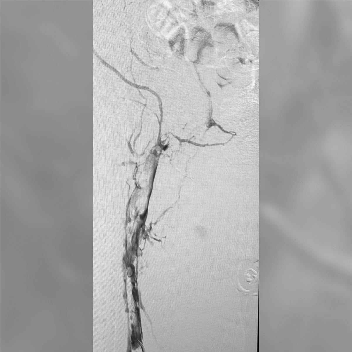 angiogram of the femoral artery showing segmental narrowing with irregular vessel contours and collateral branches
