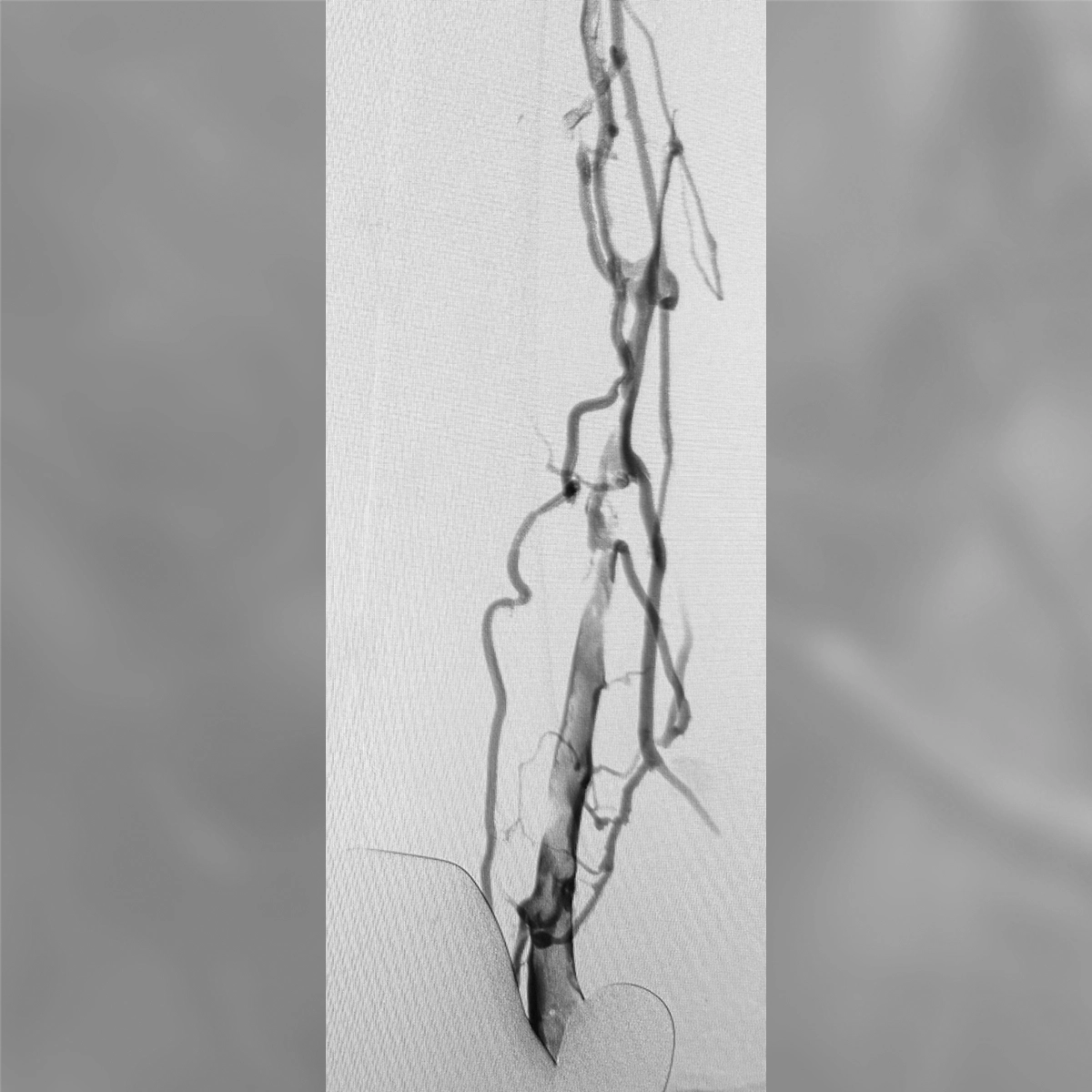angiogram of the iliac artery showing irregular contrast flow with areas of narrowing and reduced distal perfusion