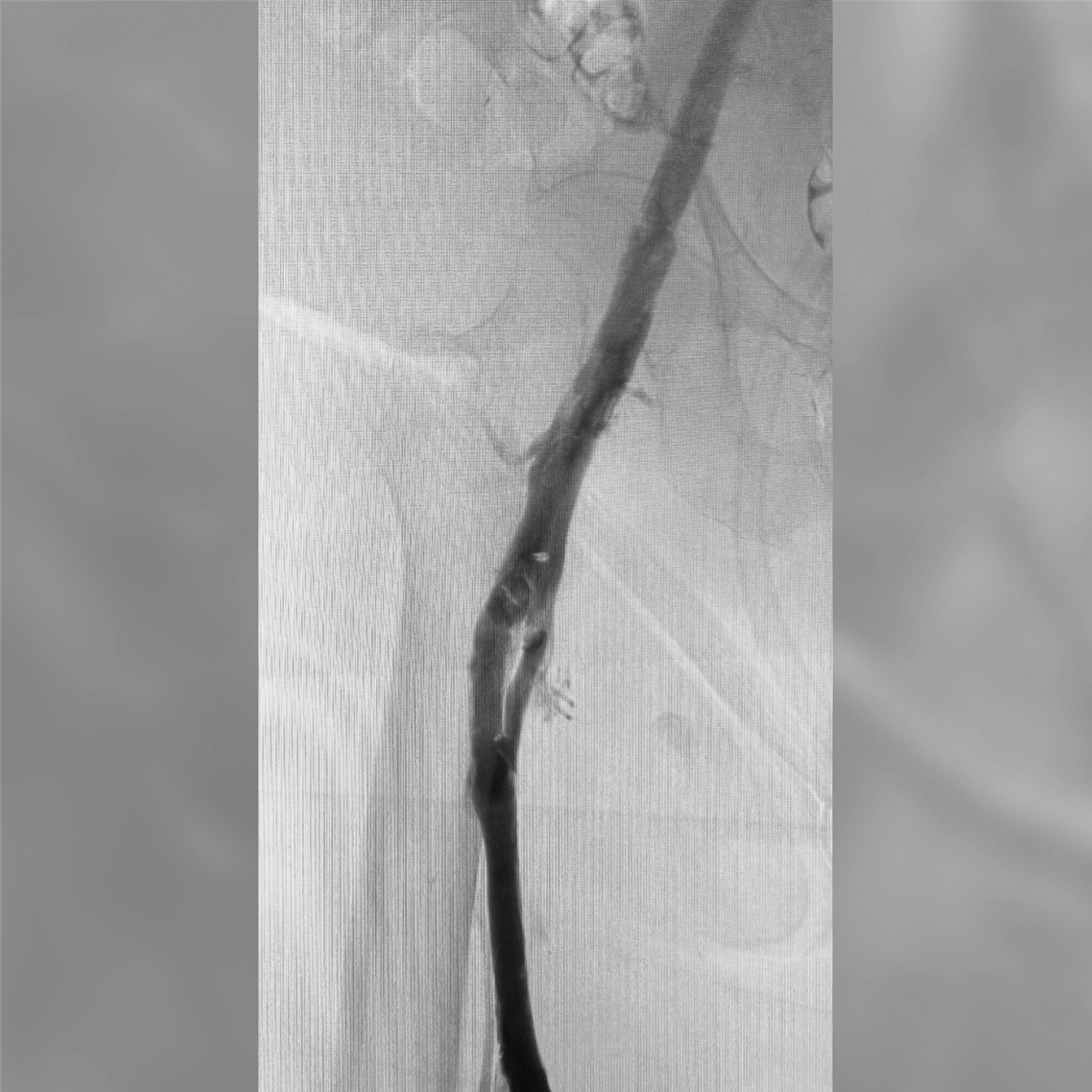 angiogram of the iliac vein showing continuous, unobstructed contrast flow through a smooth vessel following intervention