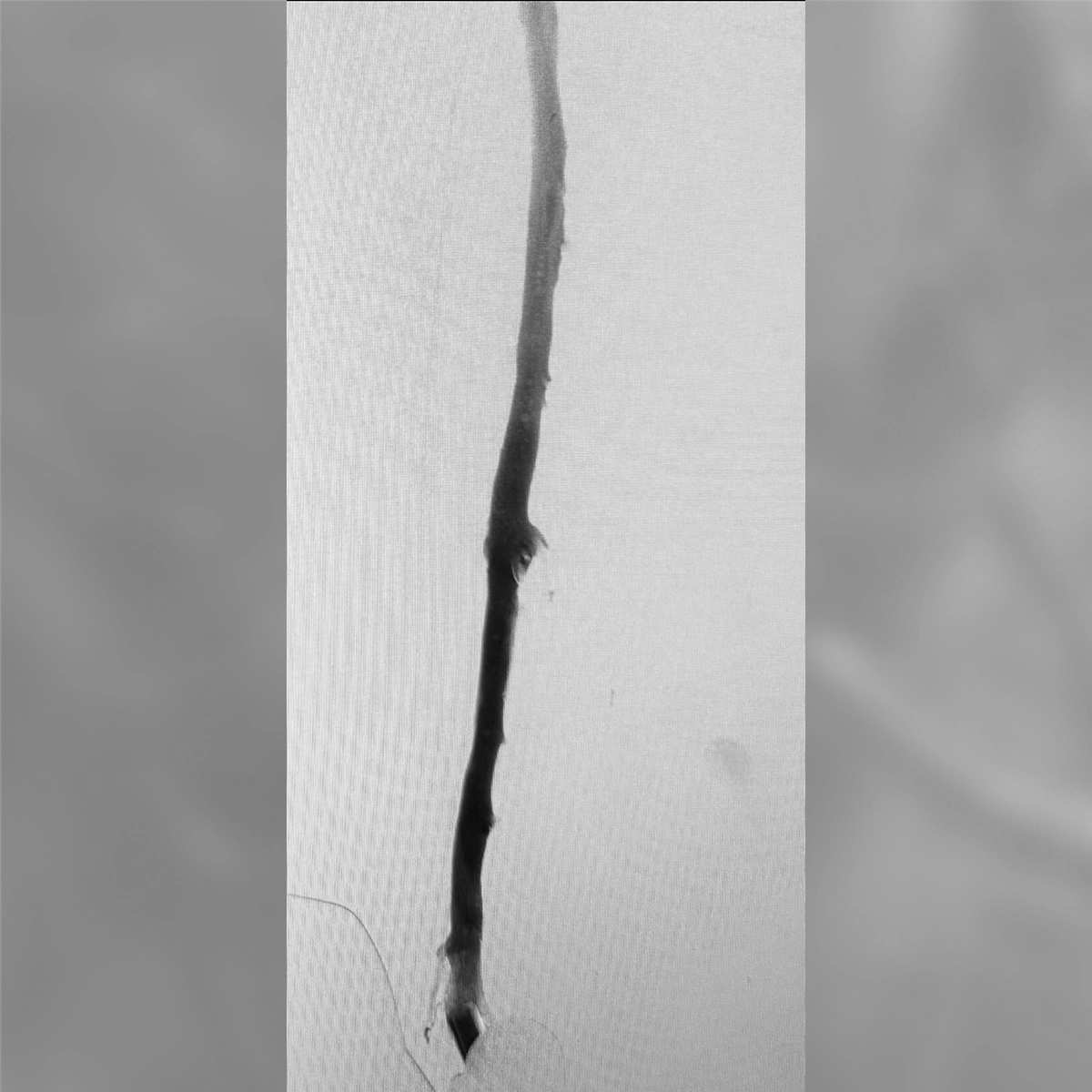 angiogram of the femoral artery showing a smooth, patent vessel with improved contrast flow after intervention