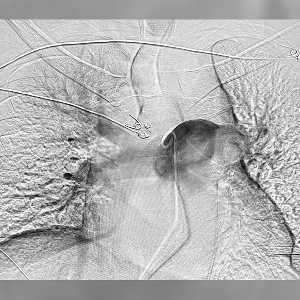 angiogram of the pulmonary arteries showing a catheter advanced into a branching vessel with contrast outlining bilateral vascular structure