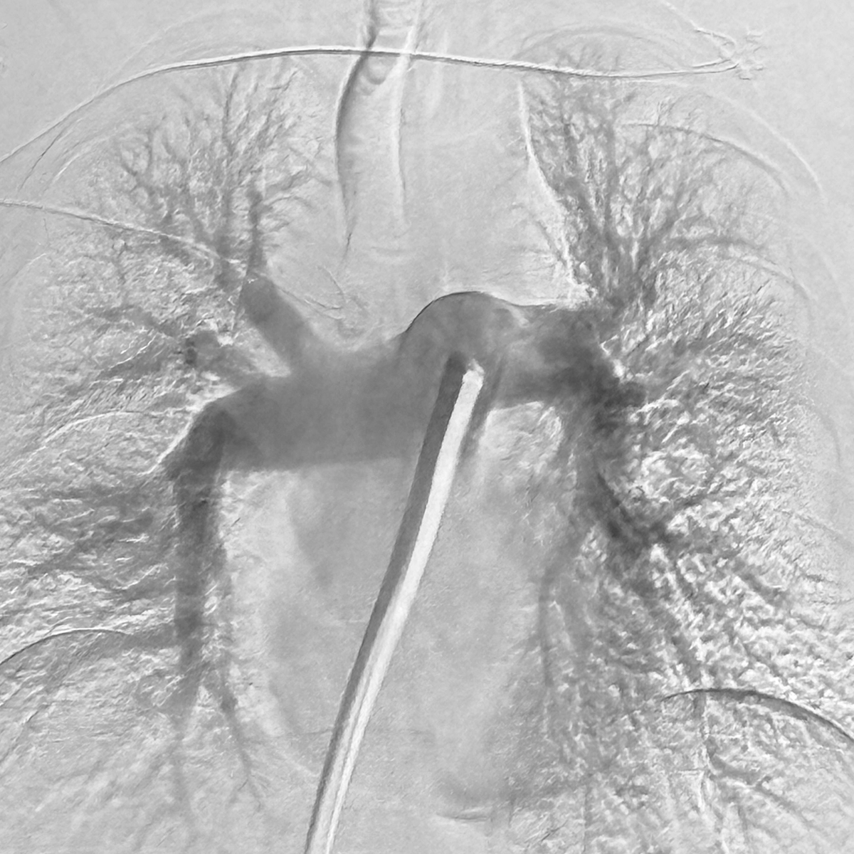 angiogram showing a catheter within the main pulmonary artery with contrast filling both lungs and a central device visible within the vessel