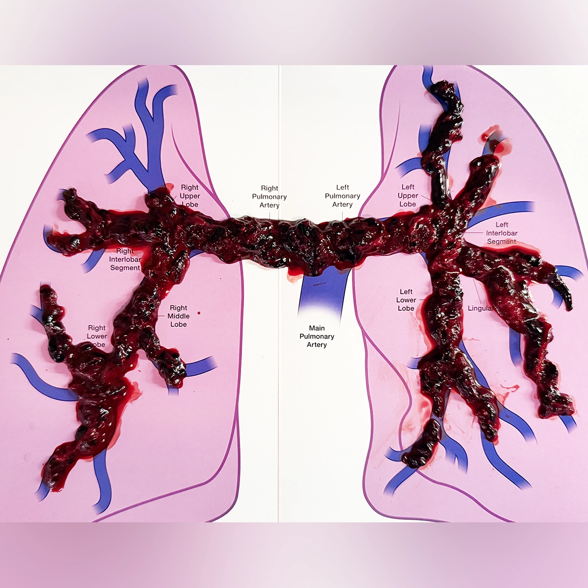 Large branching blood clot specimen laid over a labeled diagram of the lungs and pulmonary arteries, matching the shape of the bilateral arterial tree
