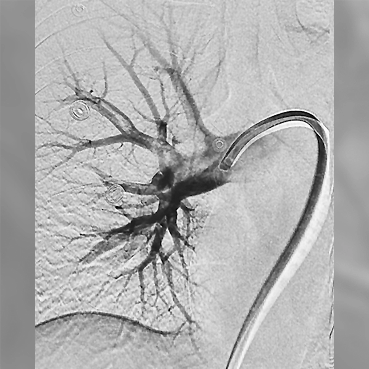 angiogram of pulmonary arteries showing reduced contrast filling with a central area of diminished perfusion before treatment