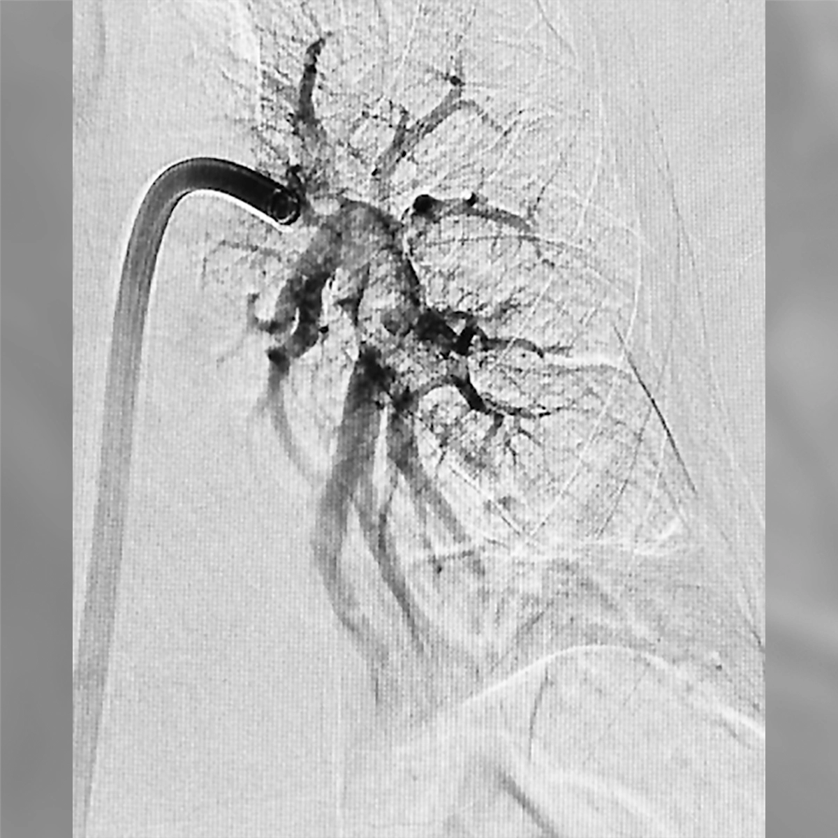 angiogram showing reduced contrast perfusion in pulmonary artery branches with areas of diminished flow before treatment