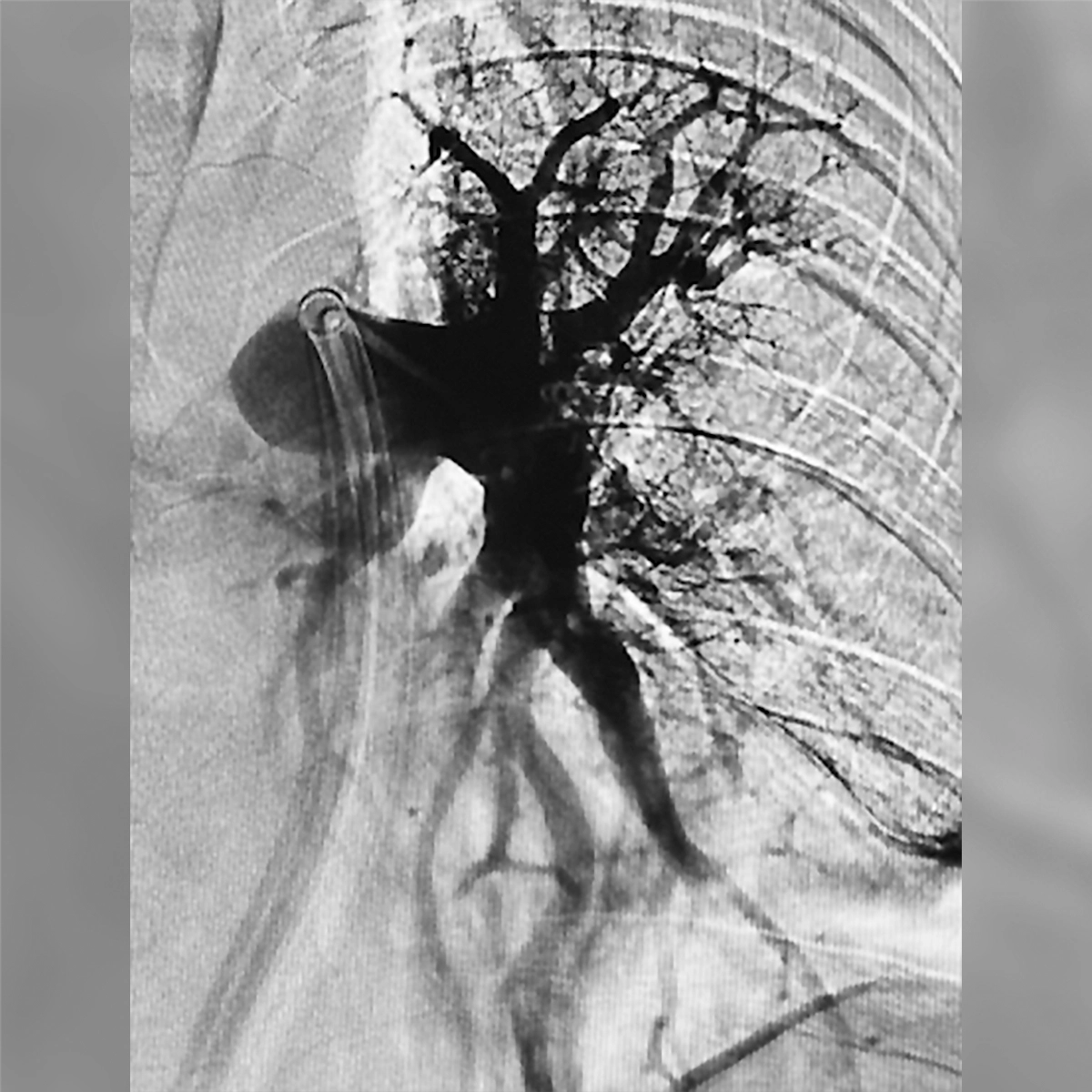 angiogram showing improved contrast perfusion through pulmonary artery branches following intervention, with a catheter positioned in the main vessel