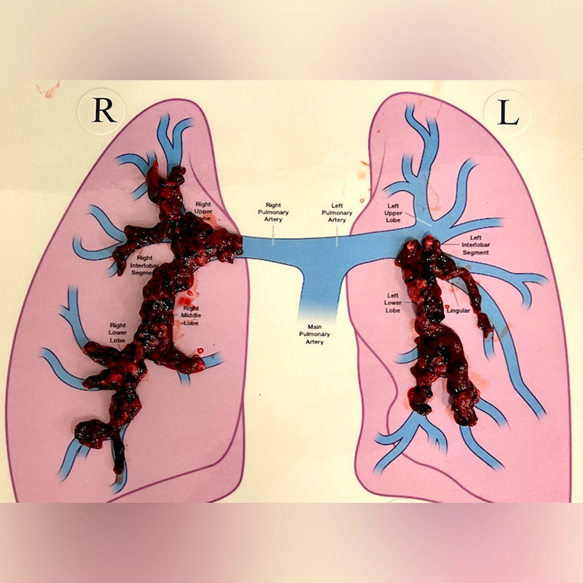 Large branching blood clot specimens placed over a labeled diagram of the lungs and pulmonary arteries, aligned with the right and left arterial trees