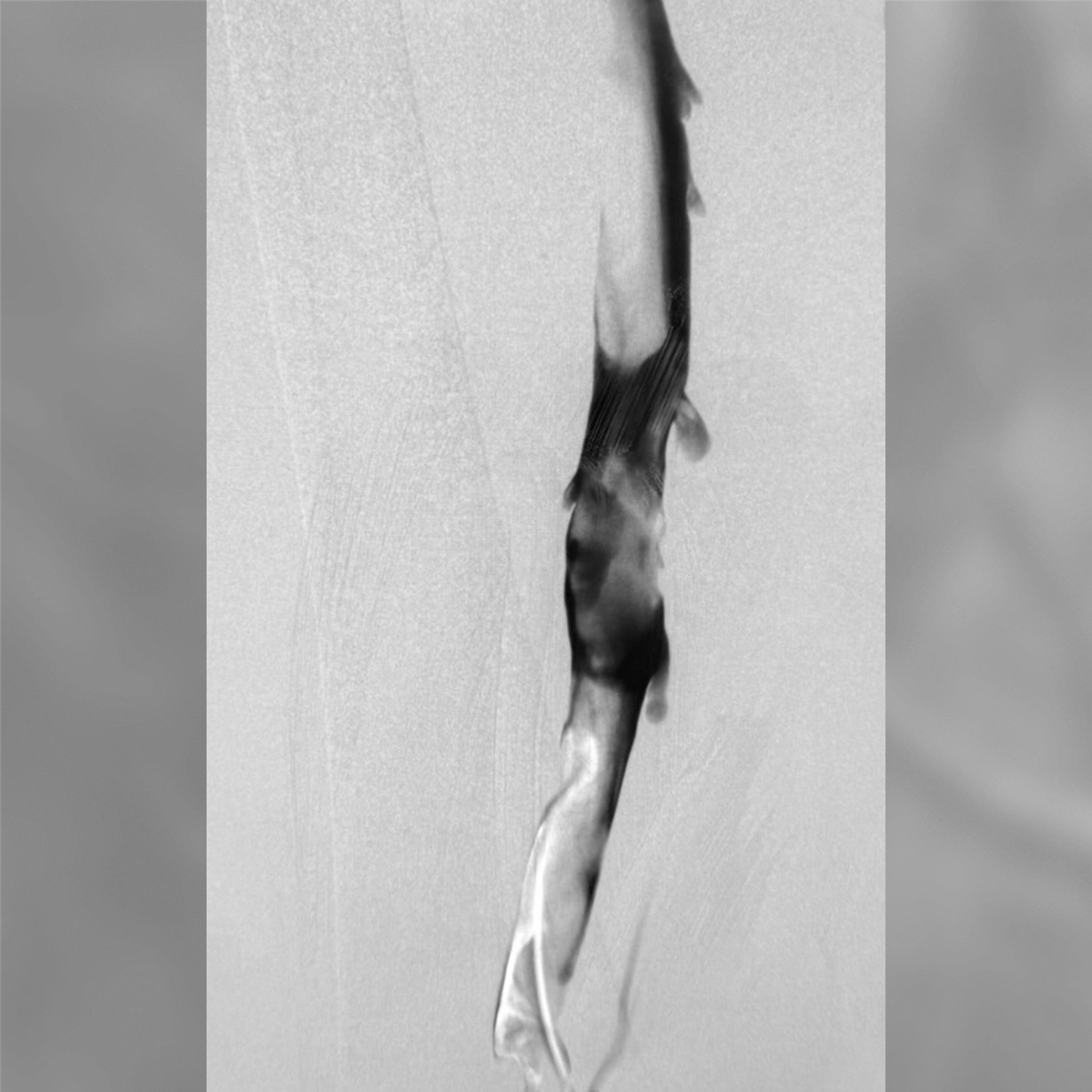 angiogram showing reduced and irregular contrast flow in a lower-extremity vein with areas of narrowing before treatment