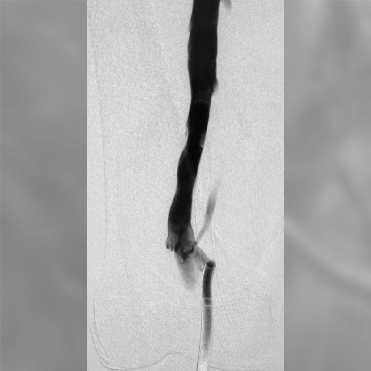 angiogram showing continuous, improved contrast flow through a lower-extremity vein following intervention, with a catheter visible