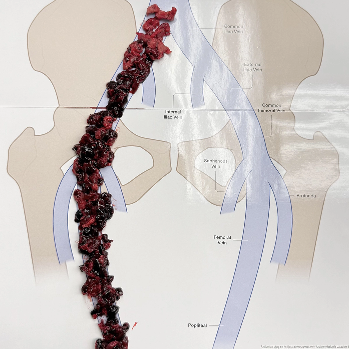 Long, irregular blood clot specimen placed over a labeled diagram of the iliac and femoral veins, aligned with the venous pathway