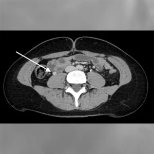 Medical imaging of abdominal area
