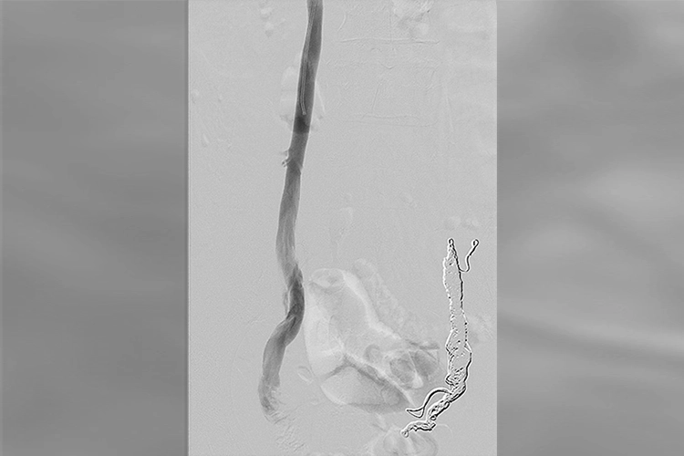 Medical imaging of vascular structure