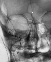 angiogram of the neurovasculature