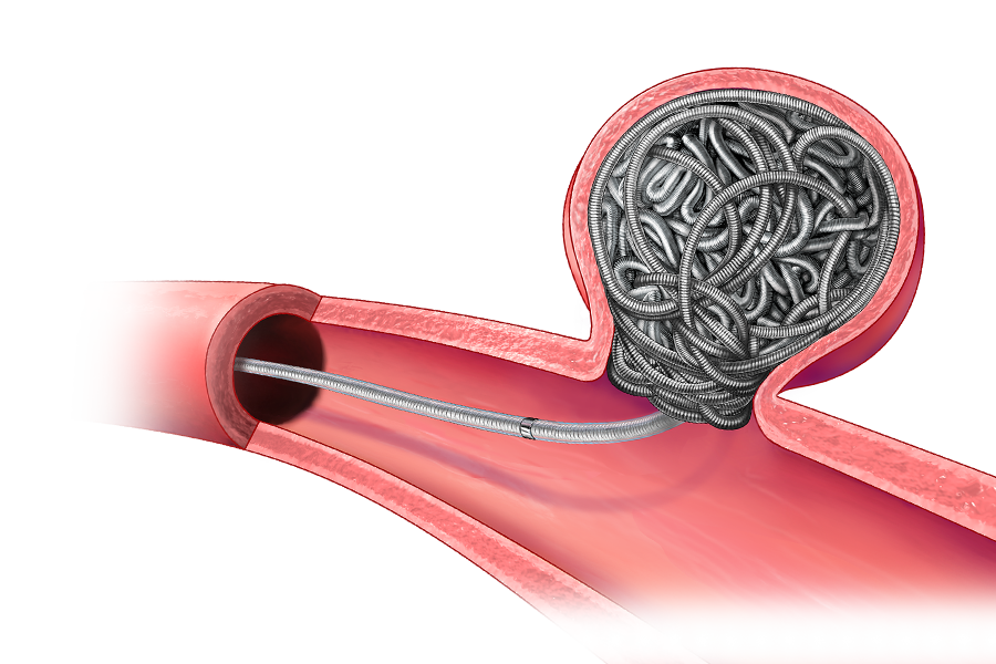 illustration of Penumbra's Ruby Coil filling a weakness in a blood vessel