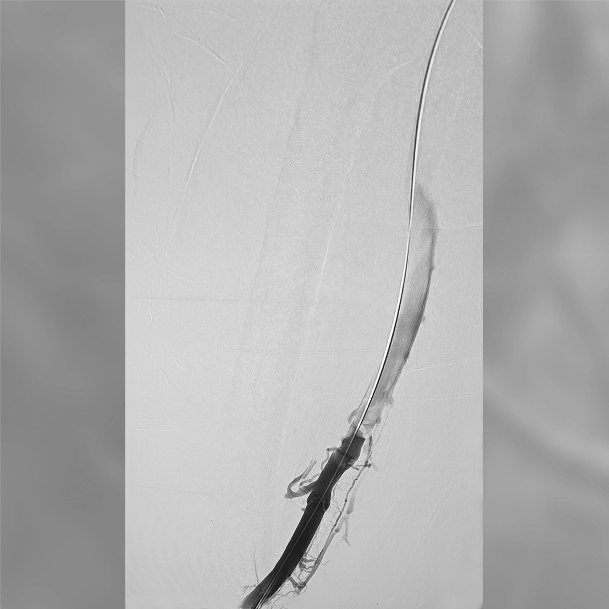 Angiogram of the femoral and iliac venous system during intervention, demonstrating contrast flow through a treated venous segment with residual intraluminal irregularity.
