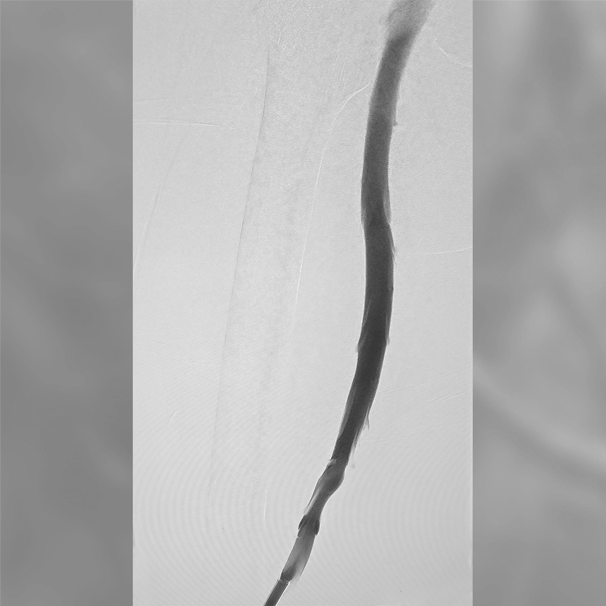 Angiogram of the femoral and iliac venous system following intervention, demonstrating improved vessel patency and inline venous flow through the treated segment.