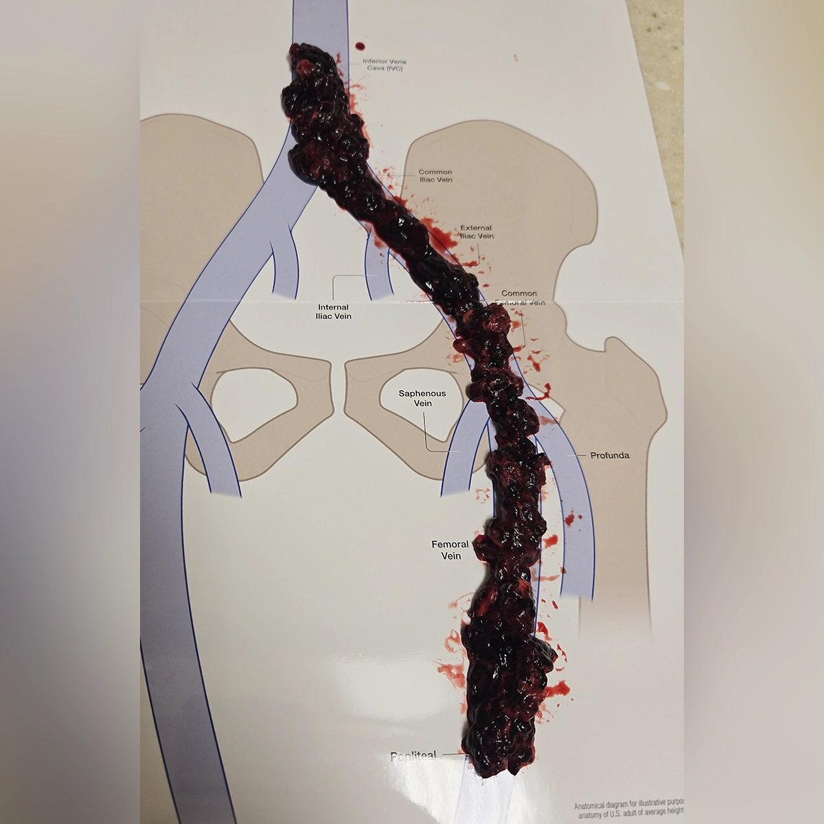Retrieved thrombus specimen displayed on an anatomical diagram of the inferior vena cava, iliac, femoral, and popliteal veins, illustrating clot removal from the lower-extremity deep venous system.