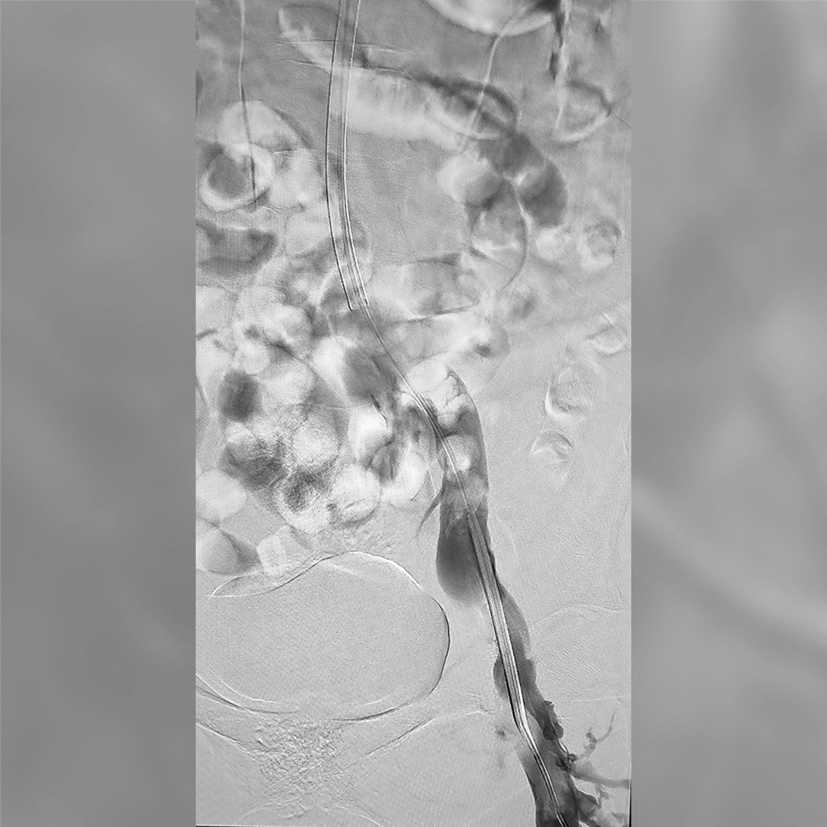 Angiogram of the iliac venous system demonstrating contrast opacification of the upper iliac vein with focal narrowing and irregular venous flow.