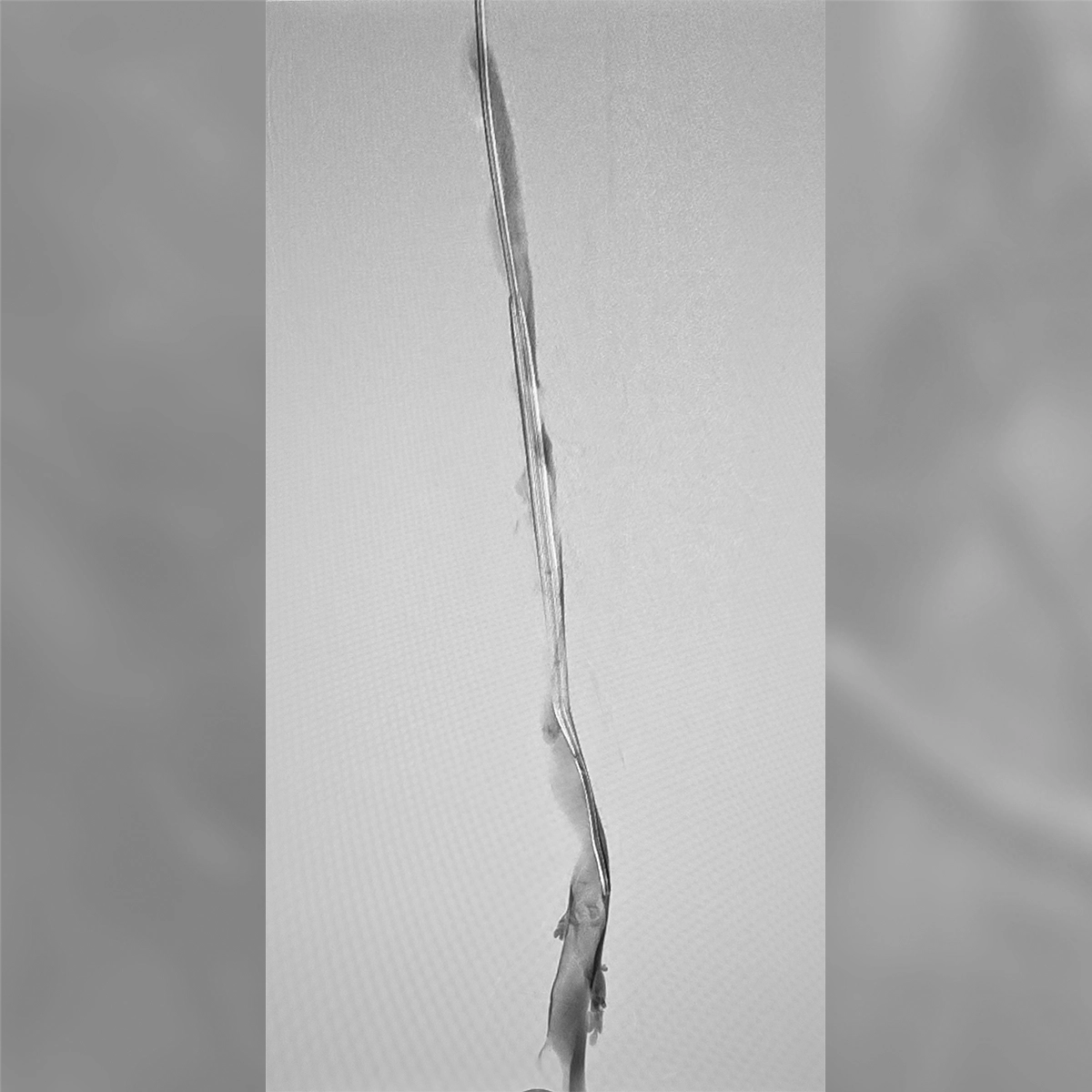 Angiogram of the lower iliac and femoral venous system demonstrating contrast flow through a narrowed venous segment with collateral vessel formation.
