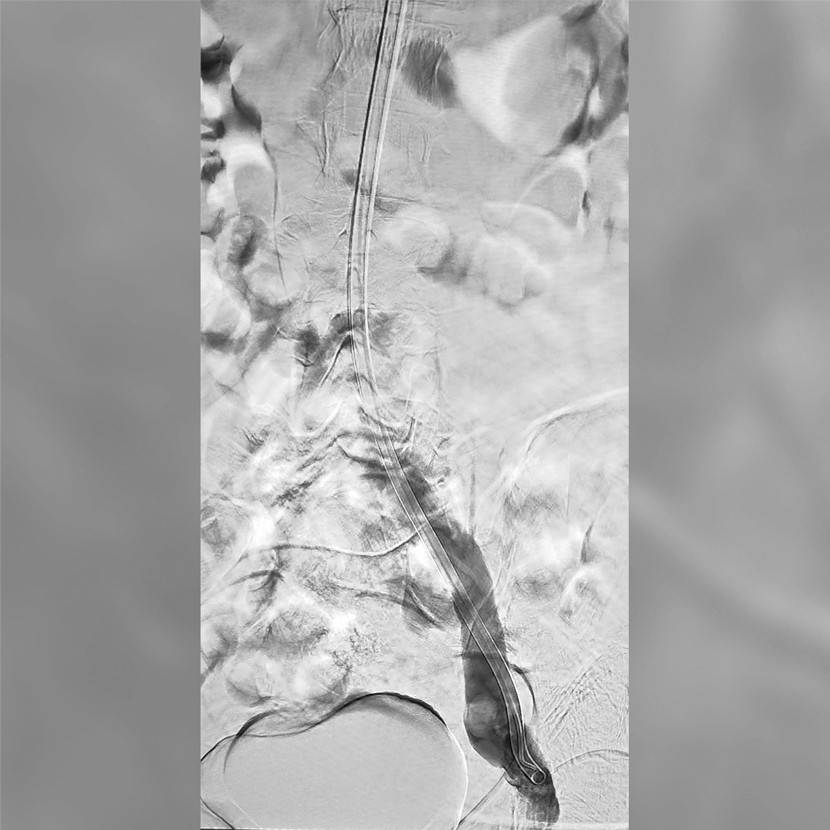 Angiogram of the upper iliac venous system following intervention, demonstrating improved vessel caliber and contrast flow through the treated venous segment.