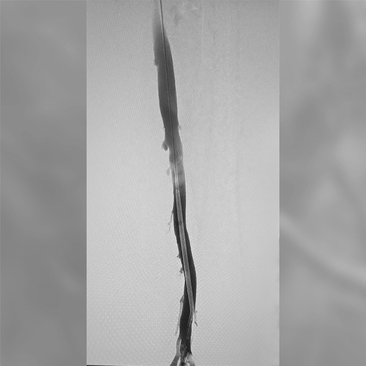 Angiogram of the lower iliac and femoral venous system following intervention, demonstrating improved inline flow through the treated venous segment.