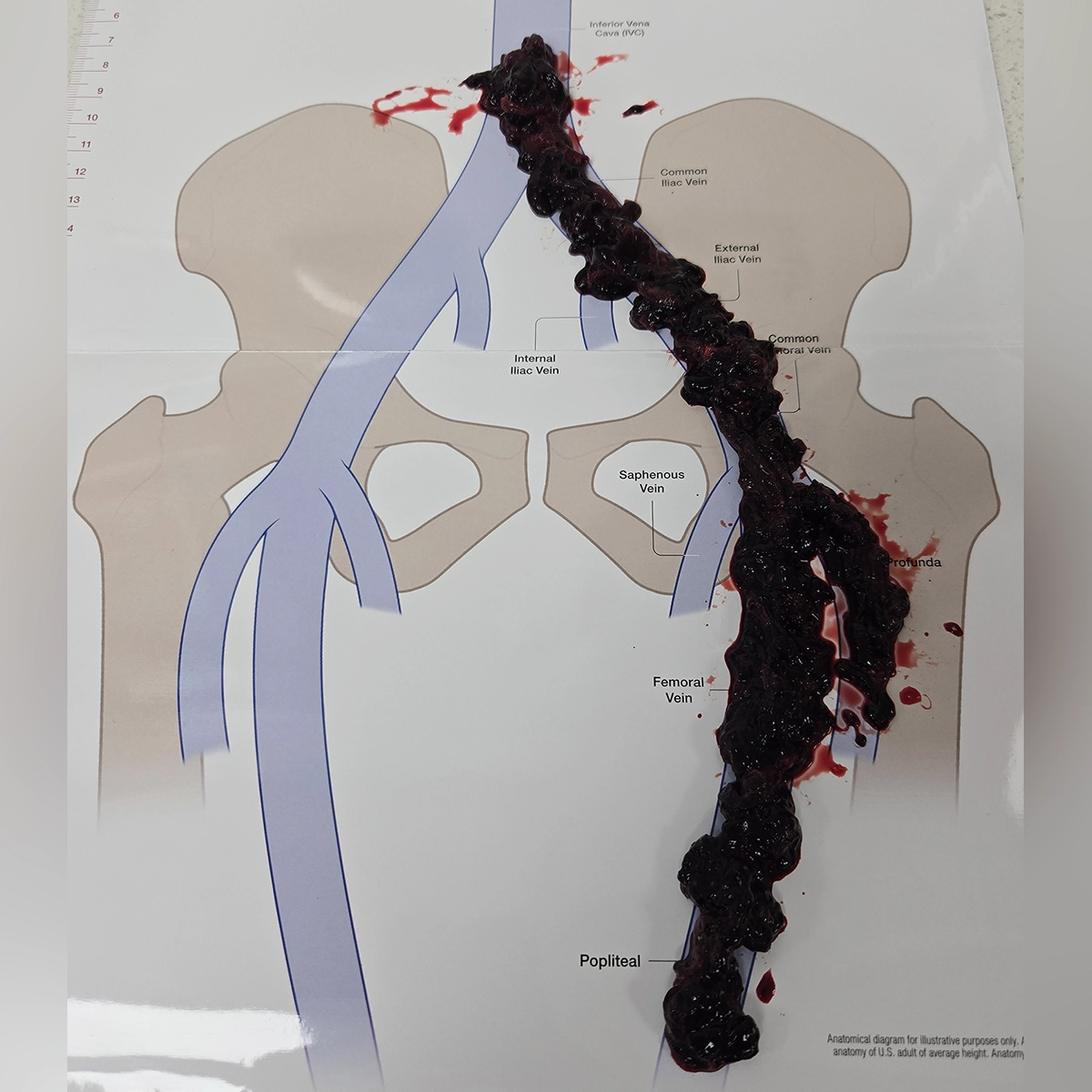 Retrieved thrombus specimen displayed on an anatomical diagram of the inferior vena cava, iliac, and femoral veins, illustrating clot removal from the lower-extremity venous system.