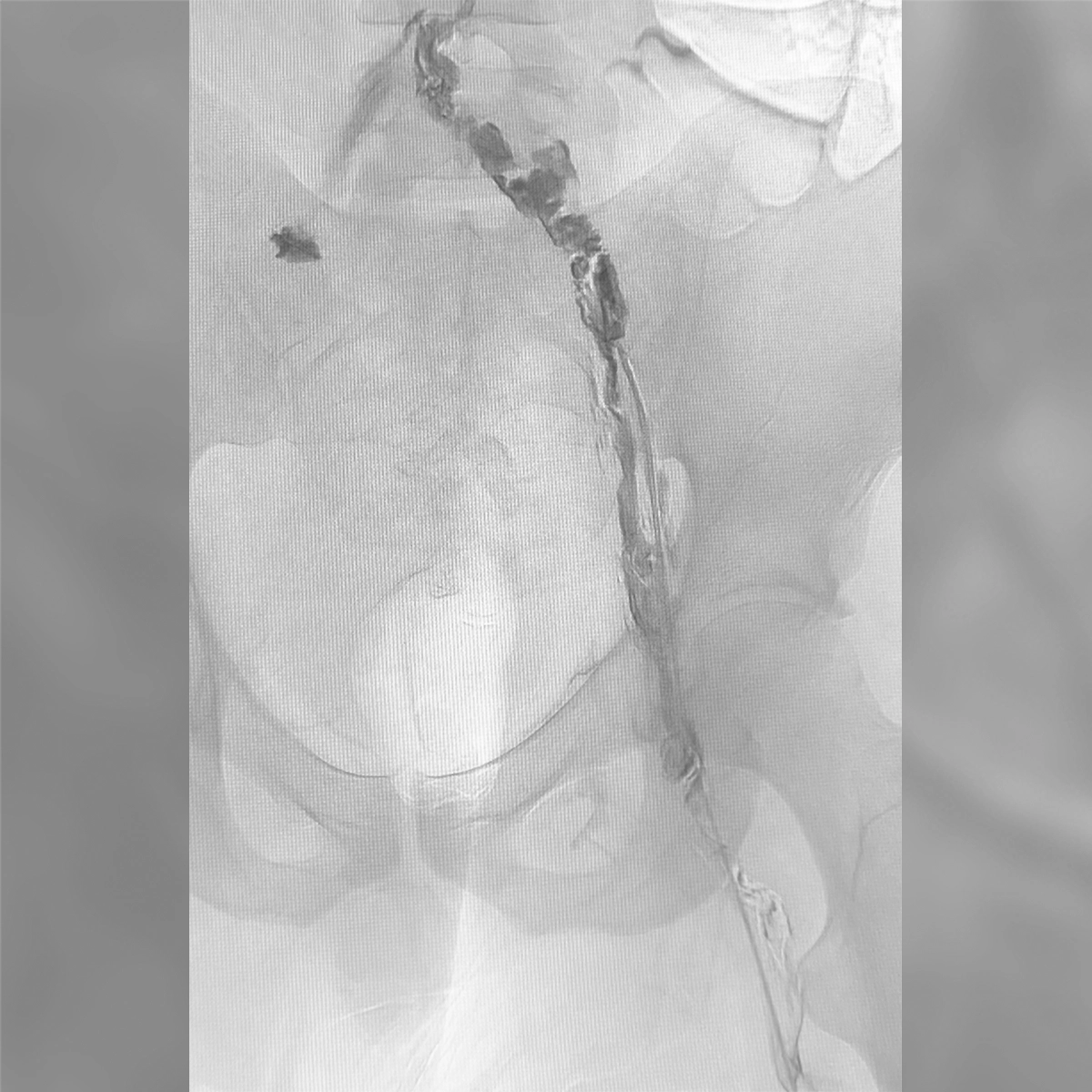 Angiogram of the iliac venous system demonstrating contrast opacification of a narrowed venous segment with collateral vessel formation.