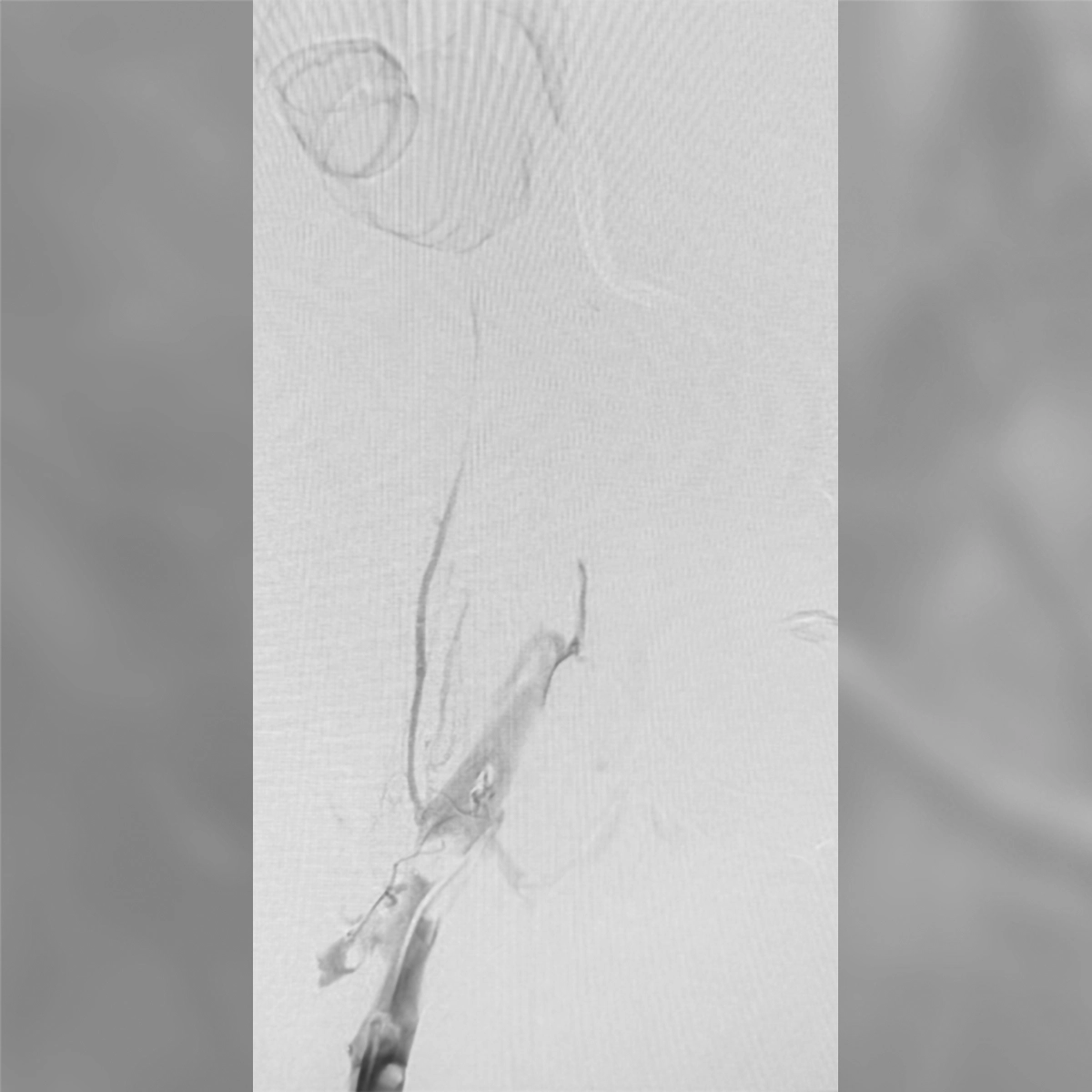 Angiogram of the iliac vein showing contrast flow through a bifurcating venous segment with focal narrowing and collateral vessels.