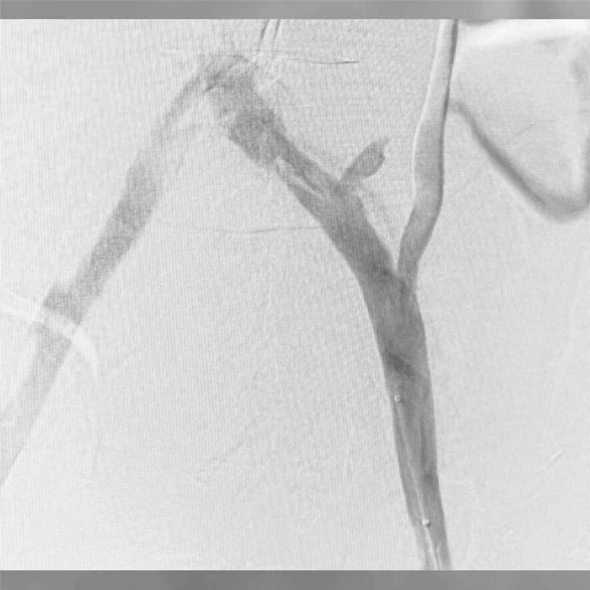 Angiogram of the iliac venous system following intervention, demonstrating improved flow through the treated venous segment.