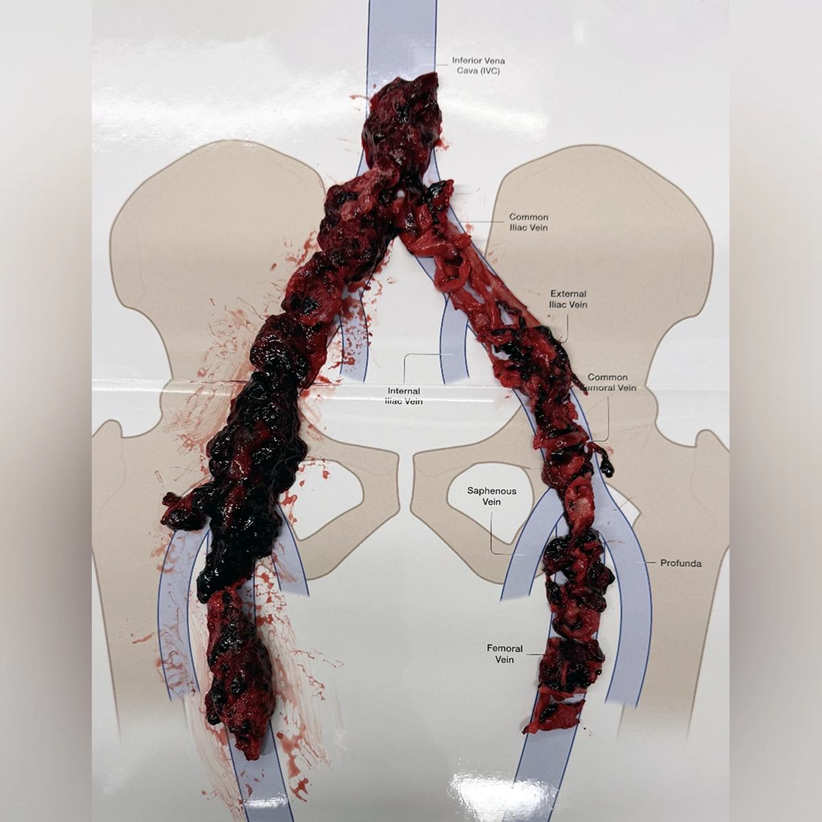 Retrieved thrombus specimens displayed on an anatomical diagram of the inferior vena cava and iliac veins, illustrating clot removal from the central and lower-extremity venous system.