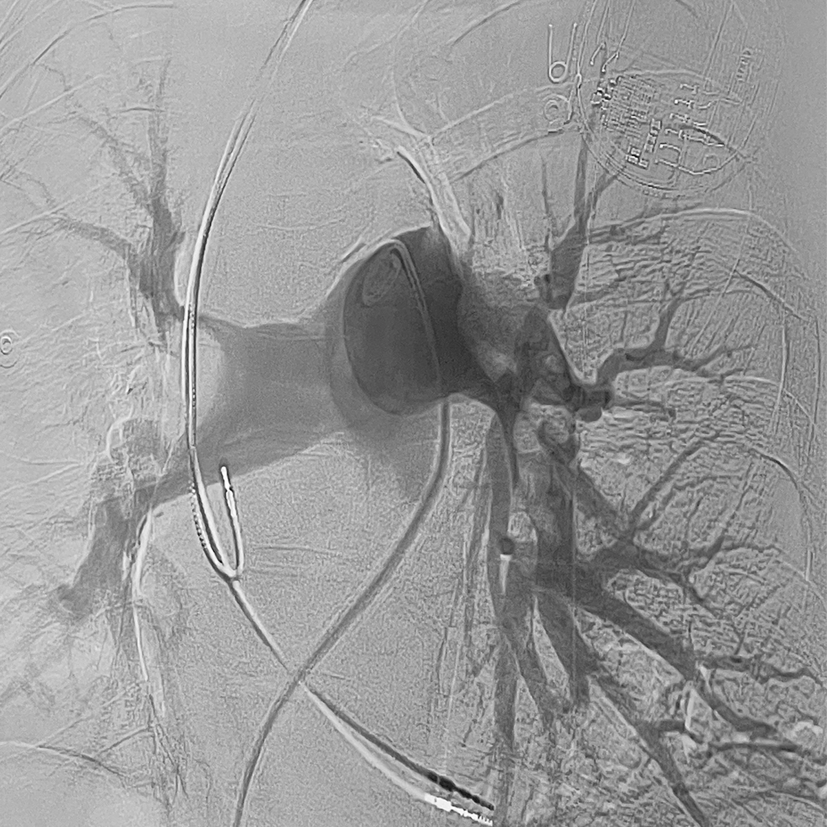 Angiogram of the pulmonary arteries demonstrating contrast filling defects within the central pulmonary vasculature, with catheters positioned in the main pulmonary artery.