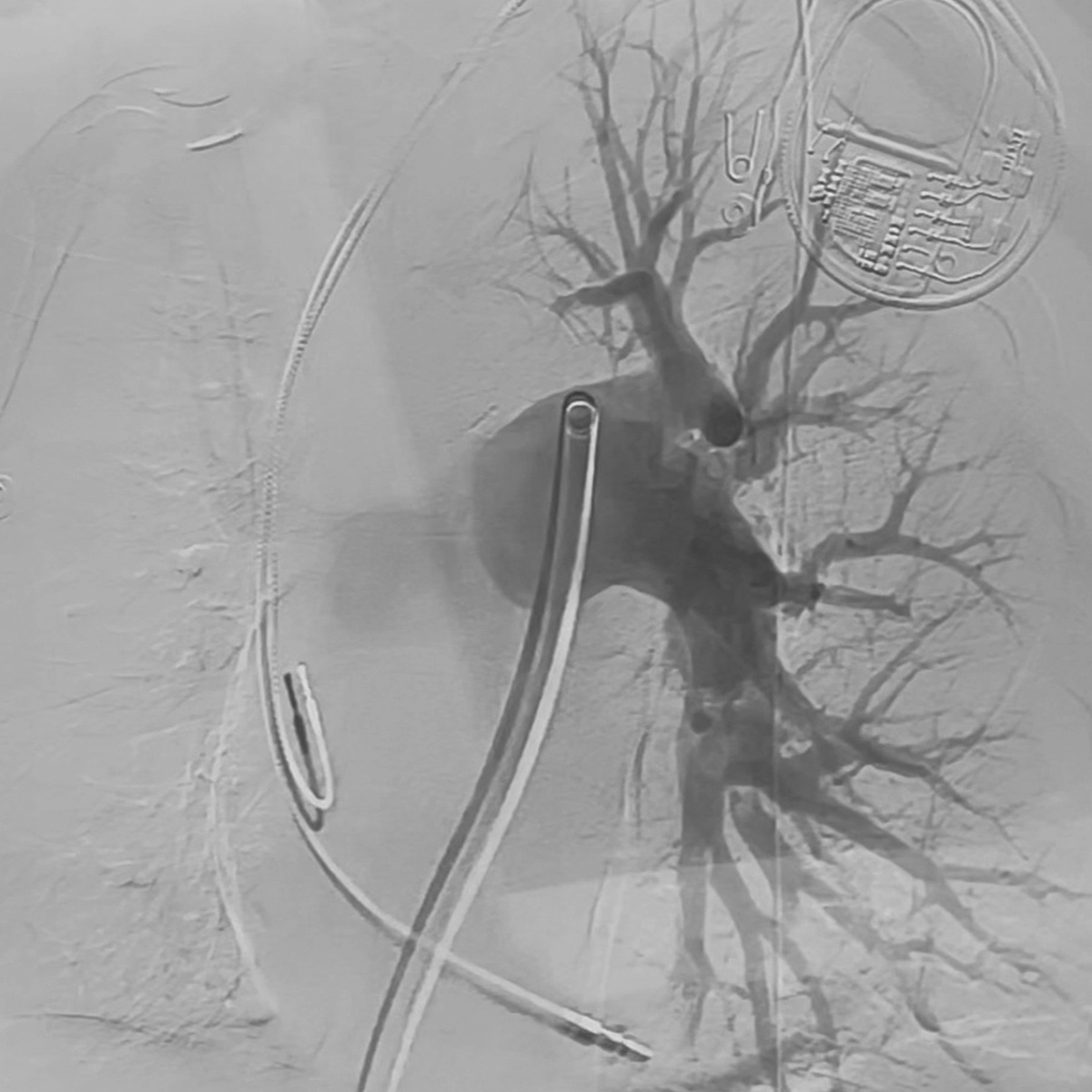 Angiogram of the pulmonary arteries following intervention, demonstrating improved contrast flow through the central and segmental pulmonary vessels.