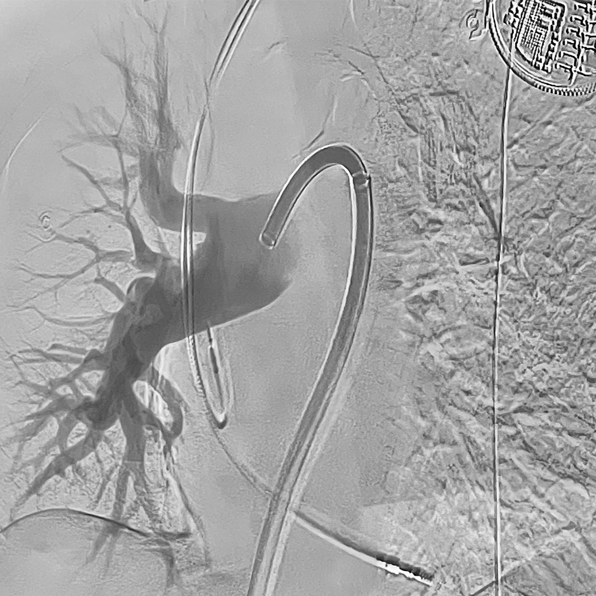 Angiogram of the pulmonary arteries showing restored perfusion of the branching pulmonary vasculature with catheters positioned in the main pulmonary artery.