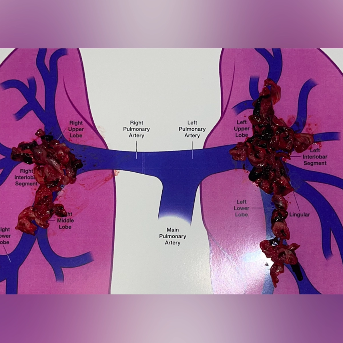 Retrieved thrombus specimens displayed on an anatomical diagram of the pulmonary arteries, illustrating clot removal from the right and left pulmonary arterial branches.