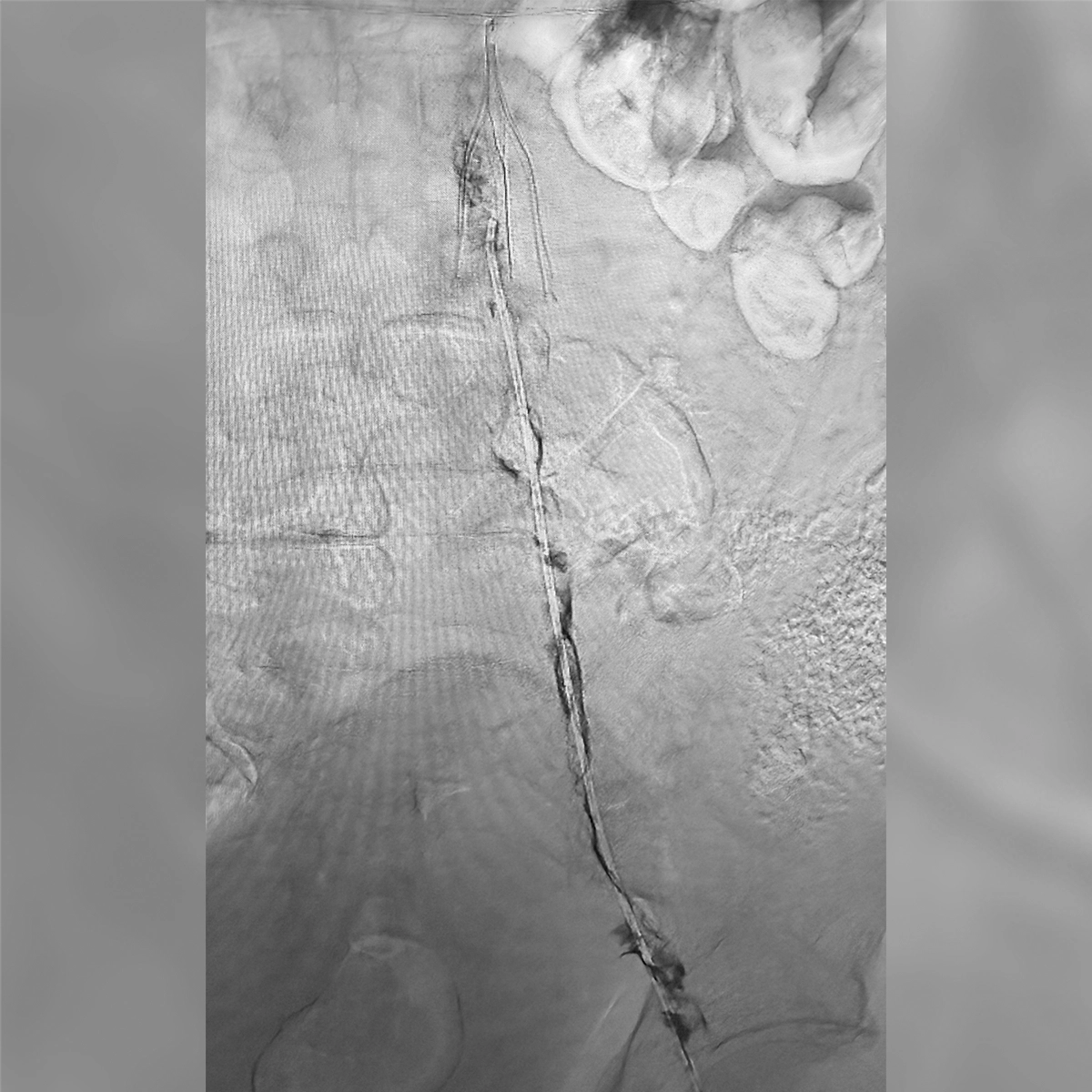 Angiogram of the inferior vena cava demonstrating contrast flow through a narrowed central venous segment.
