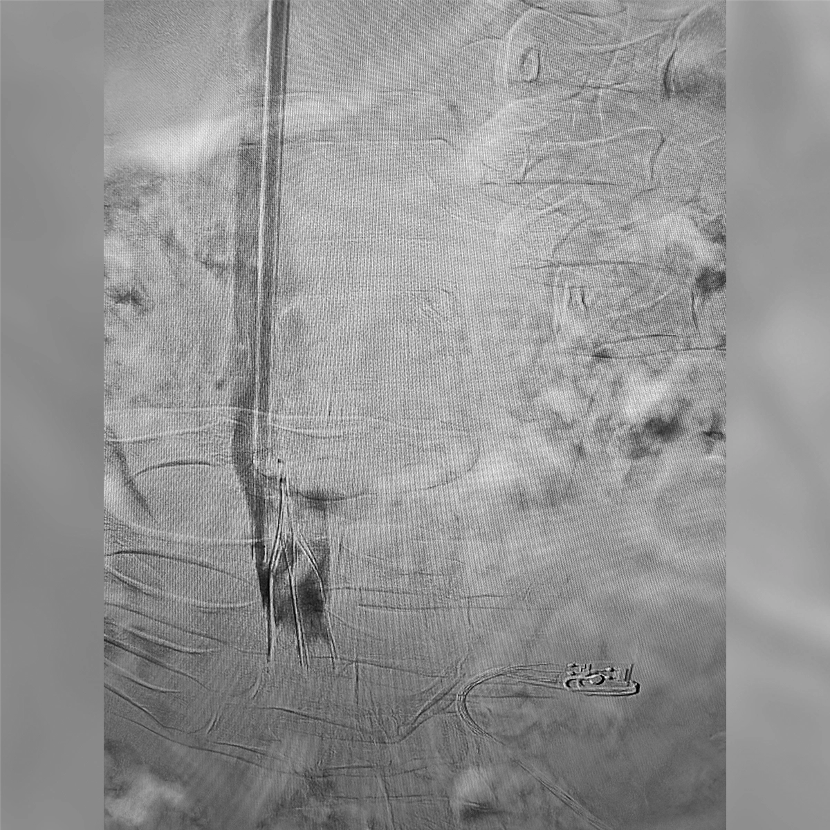 Angiogram of the inferior vena cava showing an indwelling vena cava filter within a contrast-filled venous segment.