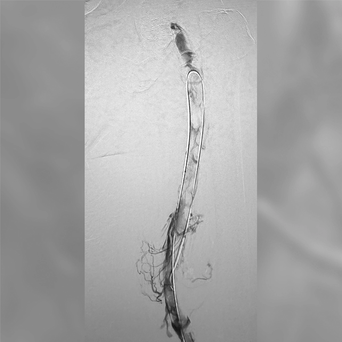 Angiogram of the inferior vena cava demonstrating contrast opacification of the central venous system with focal narrowing of the vessel lumen.