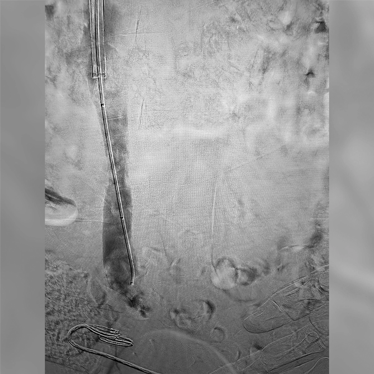 Angiogram of the inferior vena cava following intervention, demonstrating improved vessel patency with contrast flow through the treated venous segment.