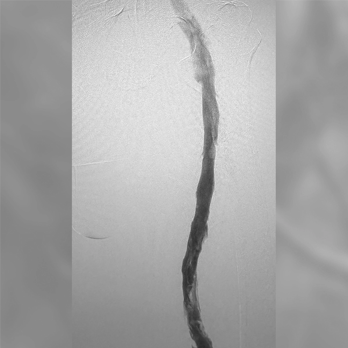 Angiogram of the inferior vena cava showing a venous stent extending through the treated central venous segment with contrast flow through the vessel.