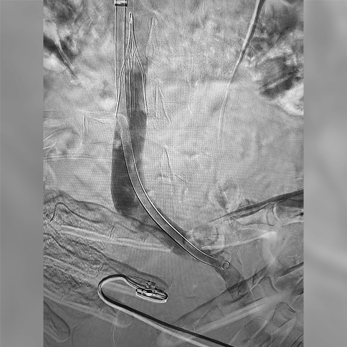 Angiogram of the inferior vena cava demonstrating restored inline flow through the treated venous segment with improved vessel caliber.