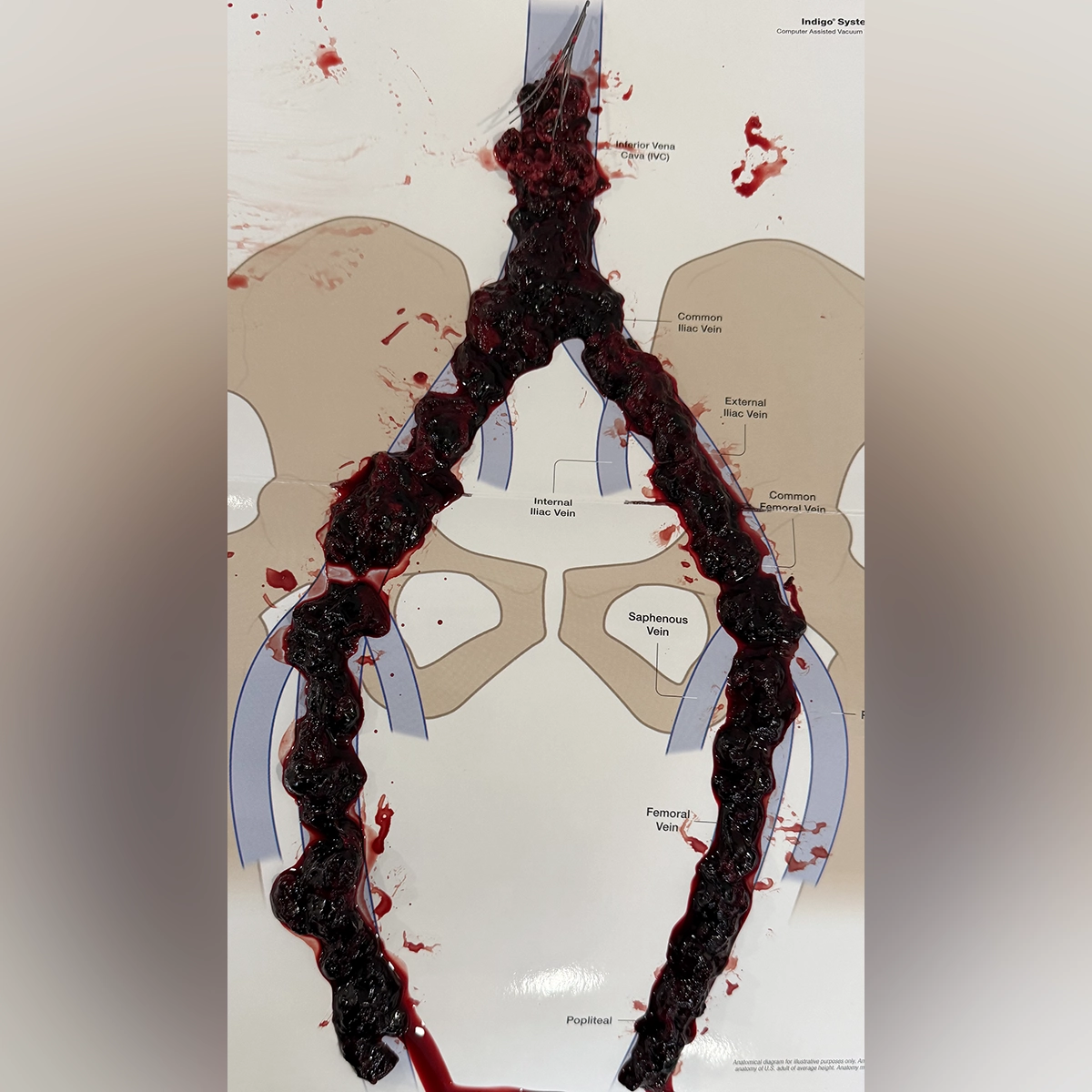 Retrieved thrombus specimens displayed on an anatomical diagram of the inferior vena cava and iliac veins, illustrating clot removal from the central venous system.