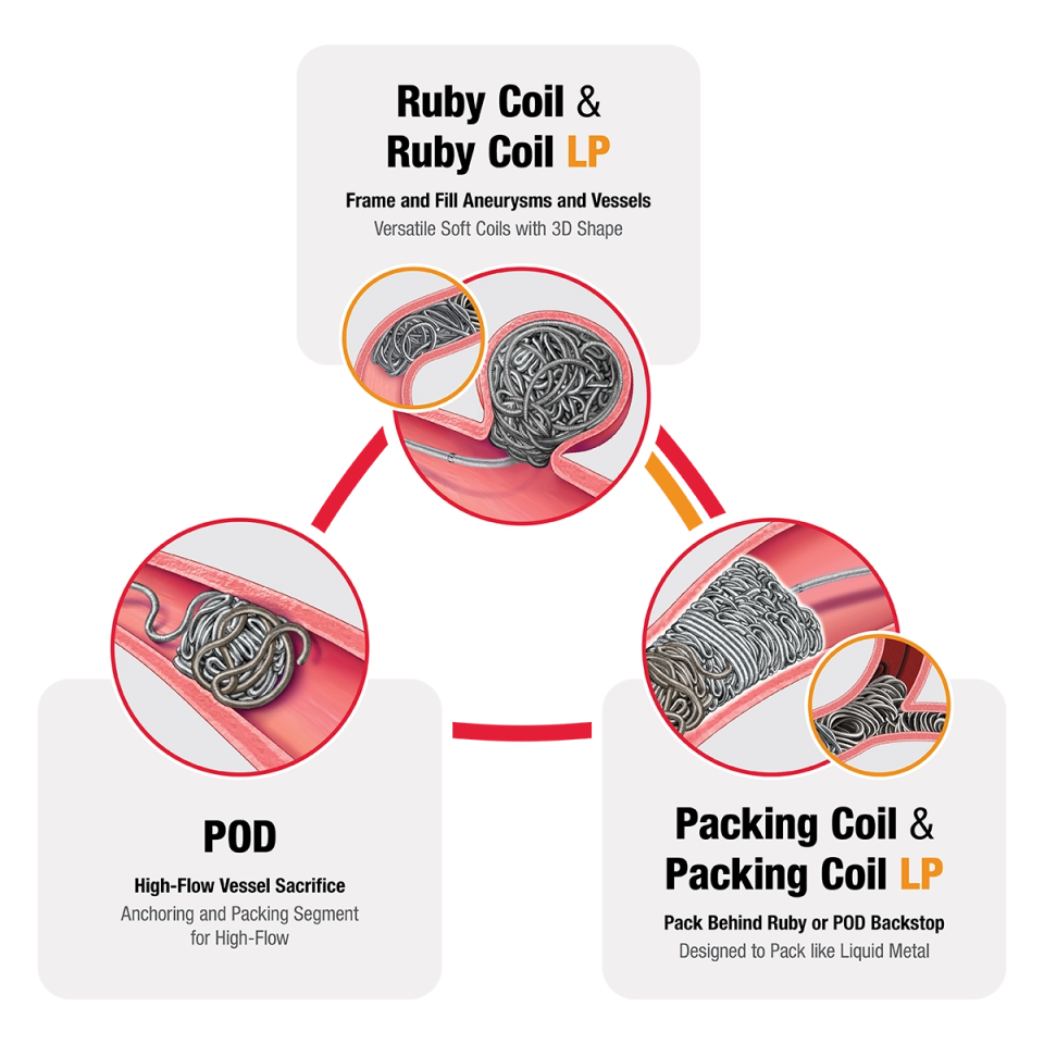 nfographic illustrating a peripheral embolization workflow using coil products. Three circular vessel illustrations are connected by red and orange arrows. The top section is labeled 'Ruby Coil & Ruby Coil LP' and includes the text 'Frame and Fill Aneurysms and Vessels' and 'Versatile Soft Coils with 3D Shape.' The lower left section is labeled 'POD' and includes the text 'High-Flow Vessel Sacrifice' and 'Anchoring and Packing Segment for High-Flow.' The lower right section is labeled 'Packing Coil & Packing Coil LP' and includes the text 'Pack Behind Ruby or POD Backstop' and 'Designed to Pack like Liquid Metal.'