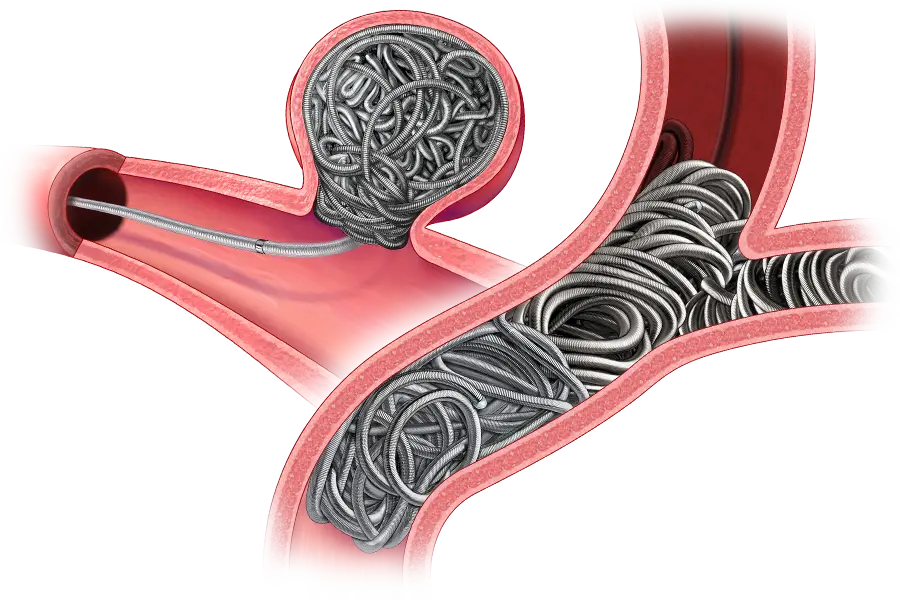 Illustration of a blood vessel cross-section containing multiple metallic-looking coils deployed within branching vessel structures and a rounded aneurysm-like cavity. A catheter and delivery wire extend into the vessel from the left side. The coils fill the vessel lumen and the rounded cavity, and the vessel walls are shown in pink and red tones. No visible text is present.