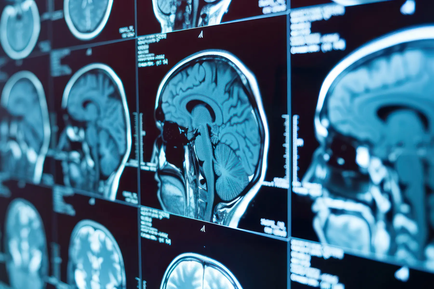 Time is Brain: The Next Evolution in the Race to Restore Blood Flow