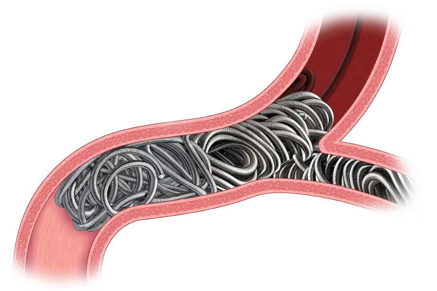 Medical illustration showing a branching blood vessel cross-section filled with densely packed metallic-looking coils. The coils occupy the vessel lumen across multiple vessel branches, with vessel walls shown in pink and red tones. No visible text is present.
